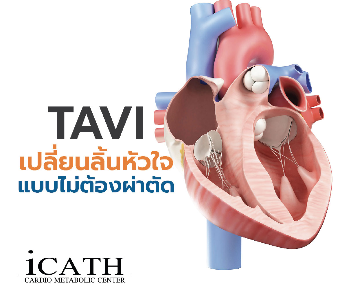TAVI / TAVR การเปลี่ยนลิ้นหัวใจแบบไม่ต้องผ่าตัดเปิดหน้าอก